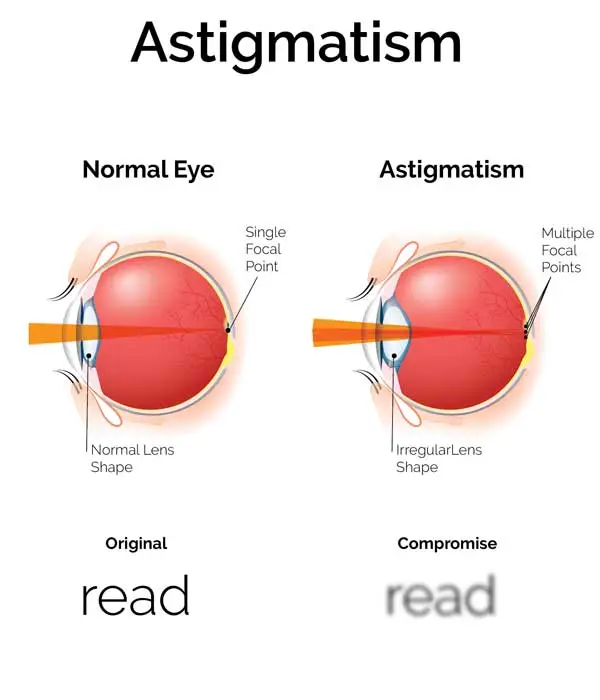 علائم آستیگماتیسم چشمی چیست و چه روش درمانی دارد؟